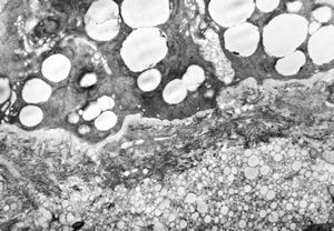 jejunum … lipid malabsorption jejunum … lipid malabsorption